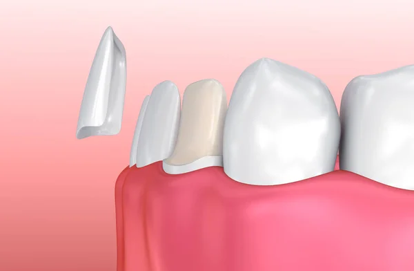 Folheados Dentários Porcelana Veneer Instalação Procedimento Ilustração — Fotografia de Stock