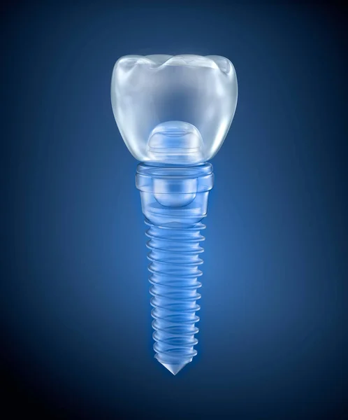 牙科钛种植体 射线视图 — 图库照片