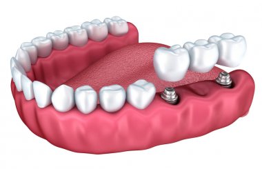 Diş implantı Instalation süreci, tıbben doğru 3d resimde beyaz stili