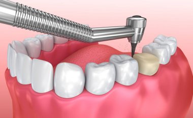 Diş crown yükleme işlemi, tıbben doğru 3d çizim