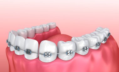 Diş telleri üzerinde beyaz izole dişli. Tıbben doğru 3d çizim 
