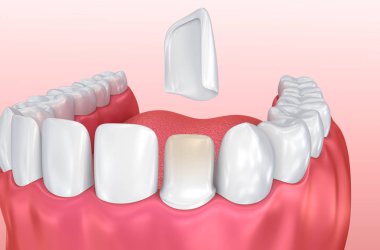 Dental Veneers: Porcelain Veneer installation Procedure. 3D illustration clipart
