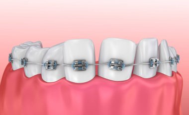 Diş telleri üzerinde beyaz izole dişli. Tıbben doğru 3d çizim 