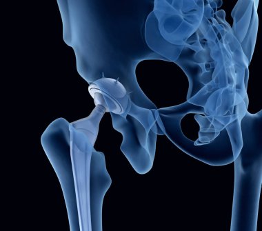 Hip replacement implant installed in the pelvis bone. X-ray view. Medically accurate 3D illustration  clipart