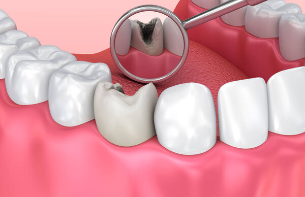 Teeth inspection with mirror. Medically accurate tooth 3D illustration