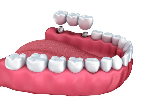 Процес Встановлення Зубів Медично Точний Ілюстрація Білого Стилю — стокове фото