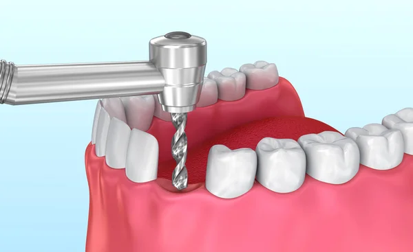 Processo Instalação Implante Dentário Ilustração Medicamente Precisa — Fotografia de Stock