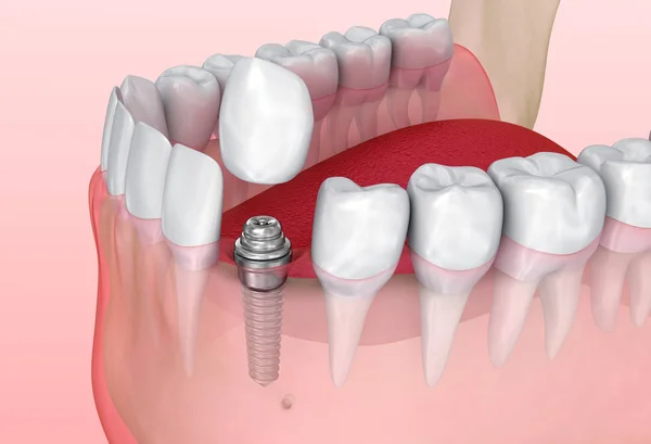 Diş Implantı Yükleme Işlemi Tıbben Doğru Çizim — Stok fotoğraf