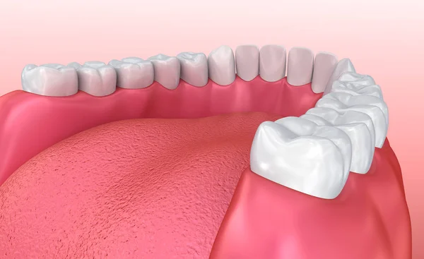 口腔口香糖和牙齿 医学上精确的牙3D — 图库照片