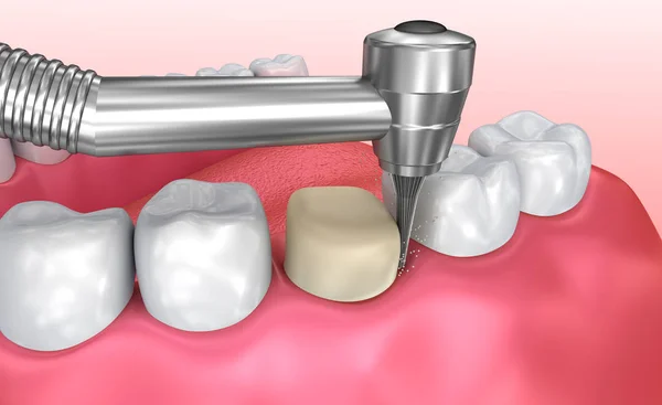 牙科冠安装过程 医学上准确的3D — 图库照片