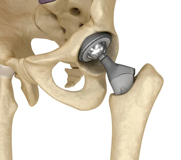 Hip Helyettesítés Implantátum Telepített Csípő Csont Orvosilag Pontos Illusztráció — Stock Fotó