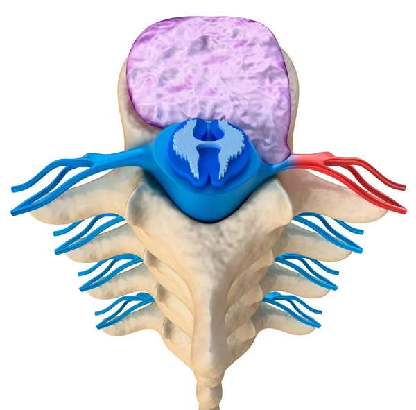 Spinal Cord Pressure Bulging Disc Illustration — Stock Photo, Image