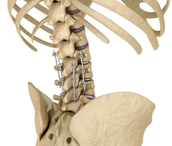 Sistema Fijación Espinal Soporte Titanio Ilustración Dientes Médicamente Precisos —  Fotos de Stock