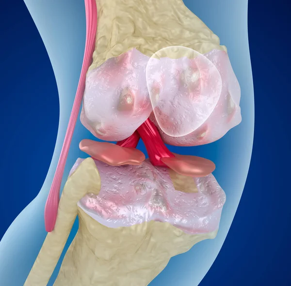 Osteoporosis Articulación Rodilla Ilustración Médicamente Precisa — Foto de Stock