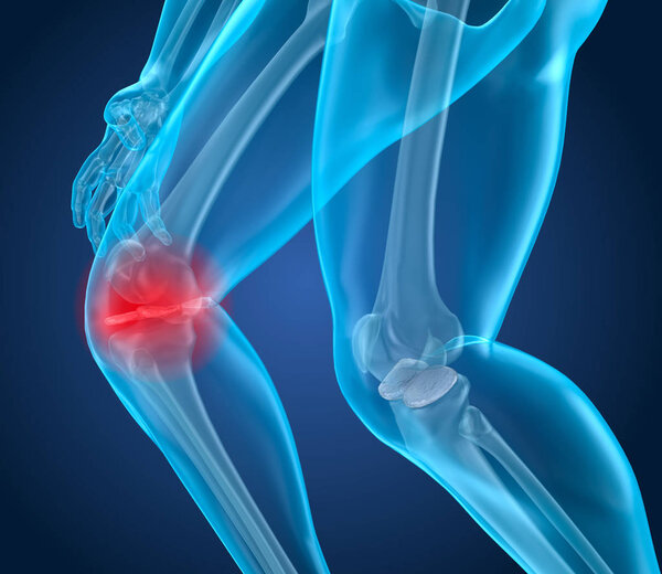 Боль в коленях Атака, человек, страдающий от спинного колена. 3D иллюстрация
 