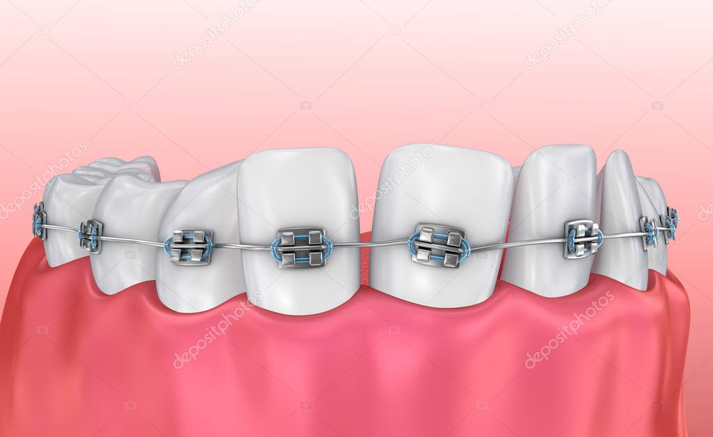 Teeth with braces isolated on white. Medically accurate 3D illustration 