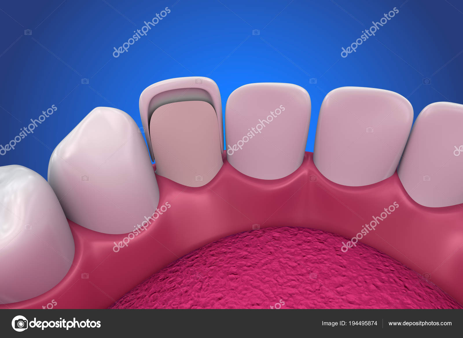Dental Veneers Porcelain Veneer Installation Procedure Illustration