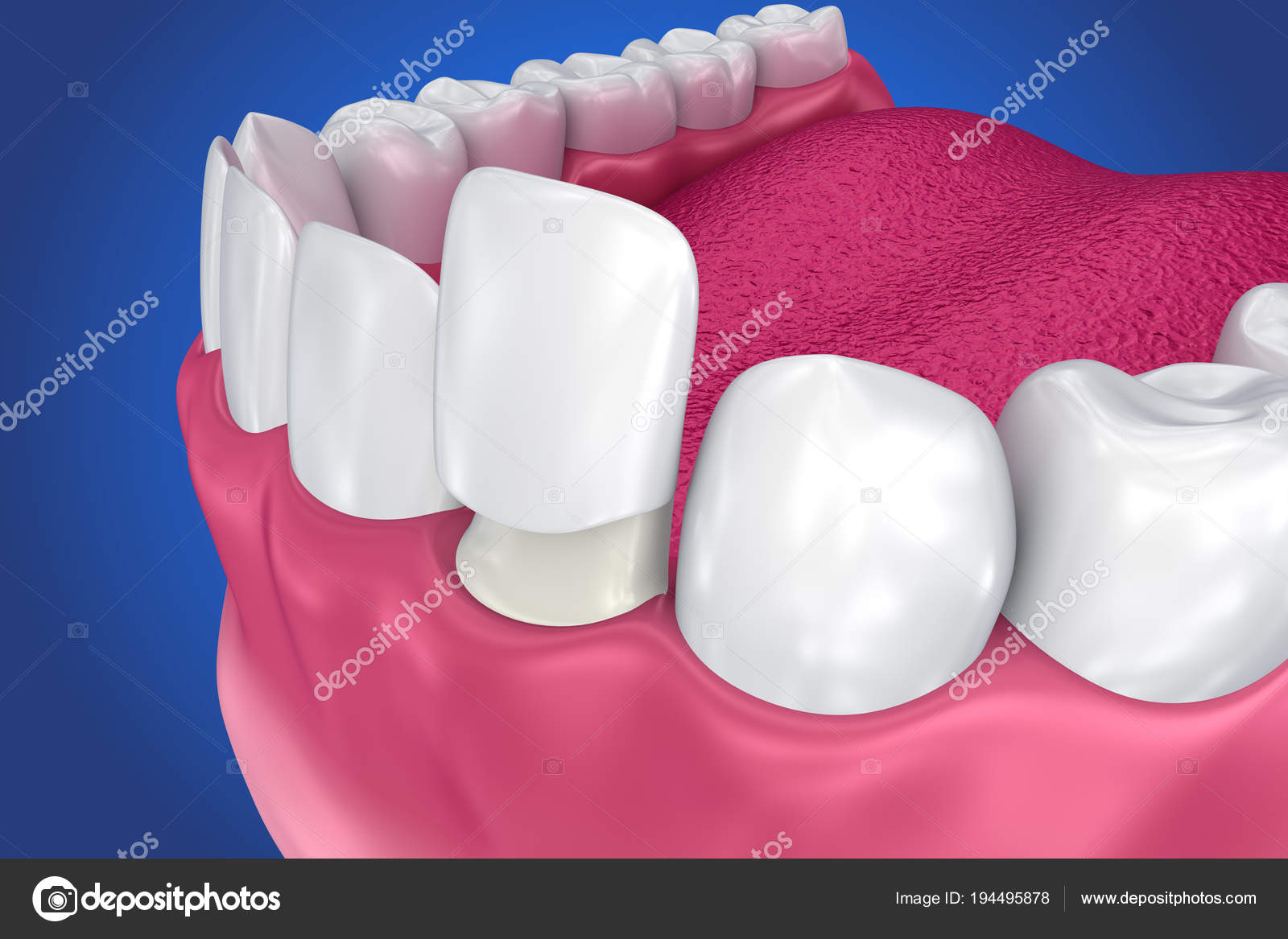 Dental Veneers Porcelain Veneer Installation Procedure Illustration
