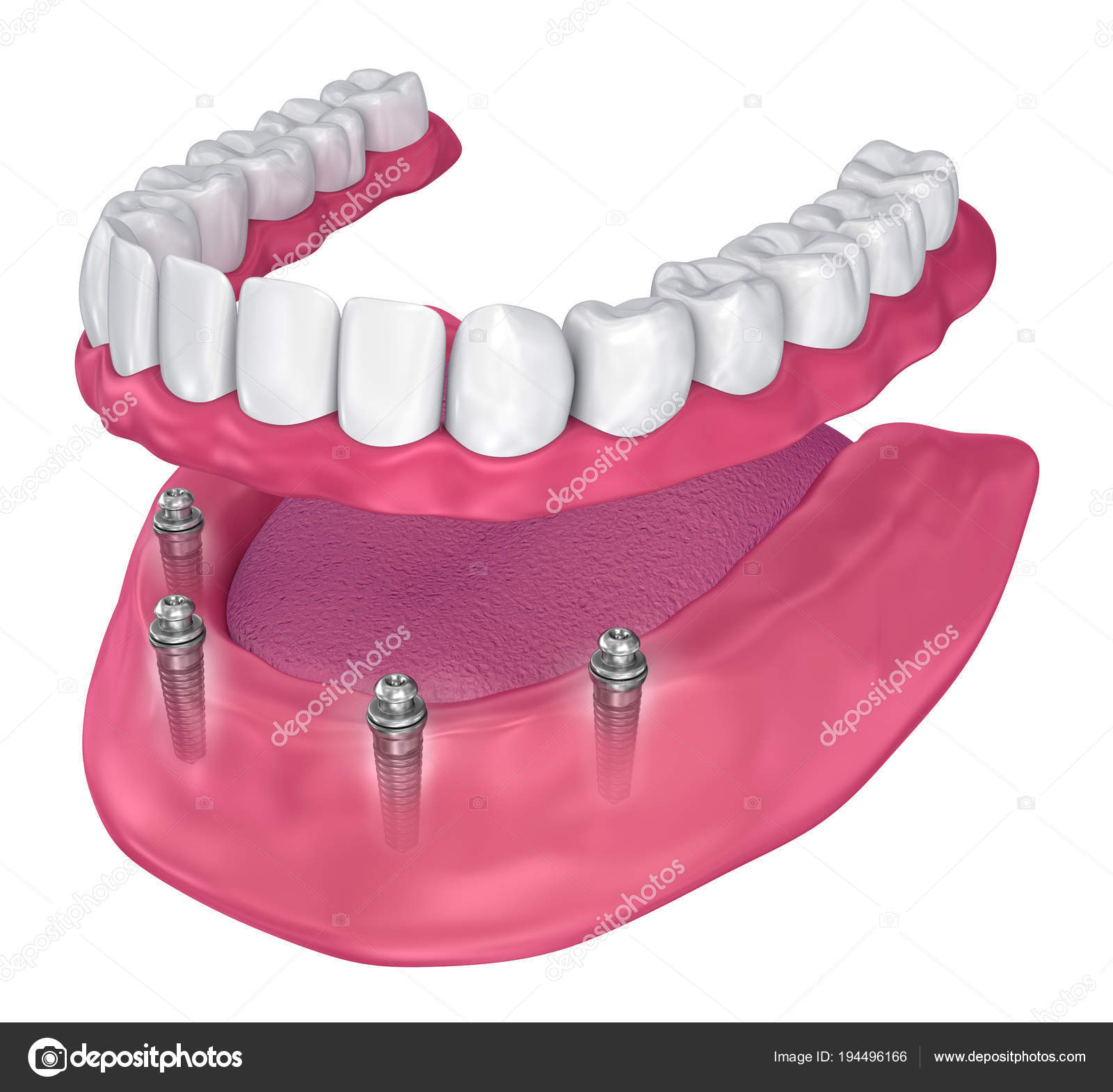 Несъемный зубной протез на 4 имплантах цена