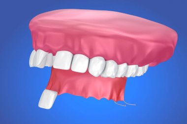 Tek eksik diş - çıkarılabilir Kısmi Protez. 3D çizim