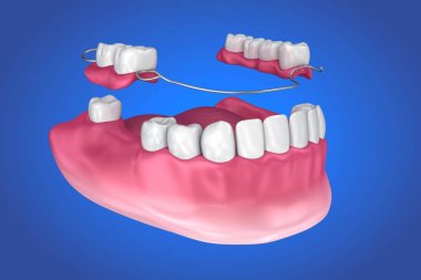 Removable partial denture. Medically accurate 3D illustration clipart