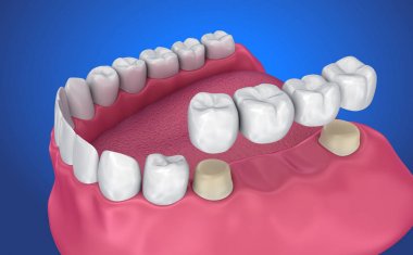 Desteklenen sabit köprü diş. Tıbben doğru 3d çizim