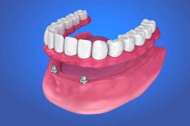 Overdenture topu ekleri üzerine oturmak için. 3D çizim