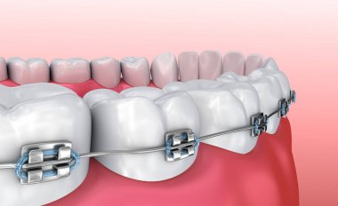 Diş telleri üzerinde beyaz izole dişli. Tıbben doğru 3d çizim 