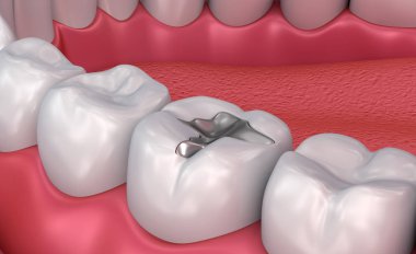 Metal diş dolguları, tıbben doğru 3d çizim