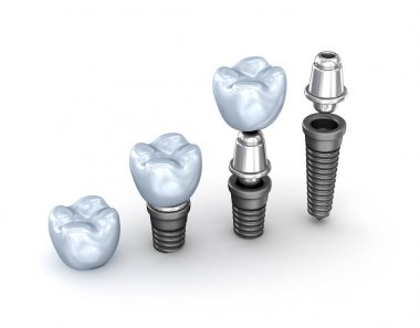 Beyaz arka plan üzerinde 3d illüstrasyon izole Diş implantları seti