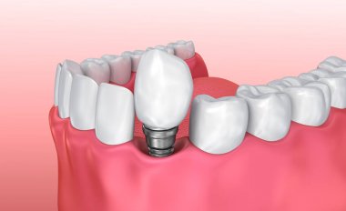 Tooth implant instalation process , Medically accurate 3D illustration white style clipart