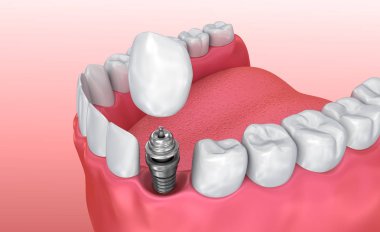 Diş implantı Instalation süreci, tıbben doğru 3d resimde beyaz stili
