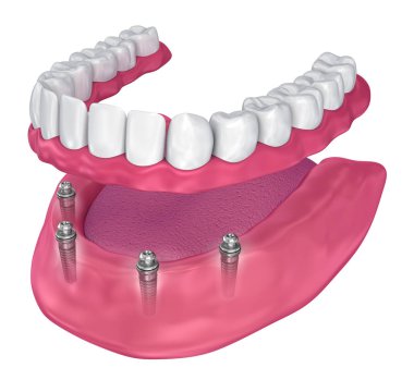 Overdenture implant - top ekleri oturmak için. 3D çizim