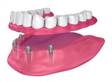 Overdenture implant - top ekleri oturmak için. 3D çizim