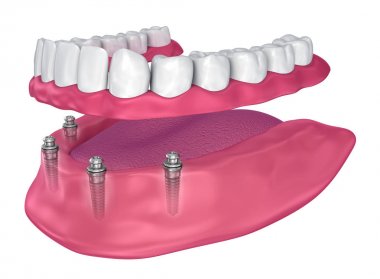 Overdenture to be seated on implants - ball attachments. 3D illustration clipart