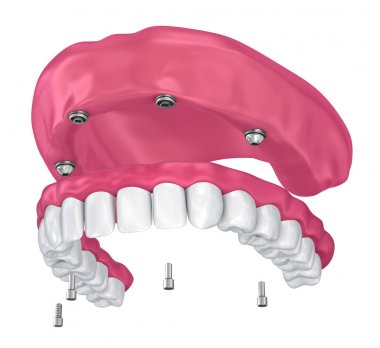 Overdenture üzerinde oturmak için ekleri implantları. 3D çizim