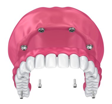 Overdenture üzerinde oturmak için ekleri implantları. 3D çizim