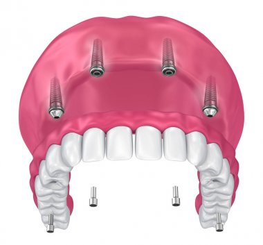 Overdenture üzerinde oturmak için ekleri implantları. 3D çizim