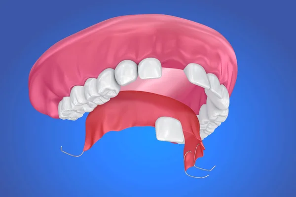 Pojedynczego Brakującego Zęba Zdejmowane Protezy Częściowe Ilustracja — Zdjęcie stockowe