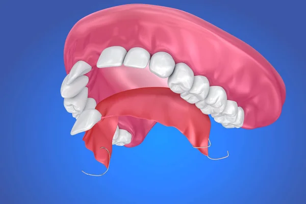 Ενιαία Λείπει Δόντι Κινητή Μερική Οδοντοστοιχία Απεικόνιση — Φωτογραφία Αρχείου