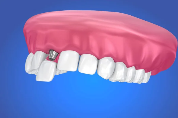Implante Dentário Processo Instalação Coroa Ilustração Medicamente Precisa — Fotografia de Stock