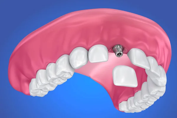 Ząb Implantu Korony Proces Instalacji Medycznie Dokładne Ilustracja — Zdjęcie stockowe