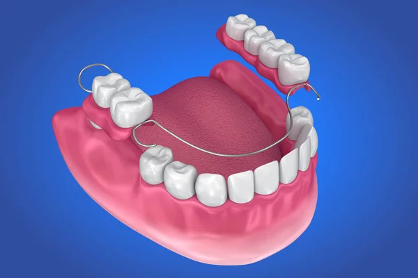 Dentadura Parcial Removível Ilustração Medicamente Precisa — Fotografia de Stock