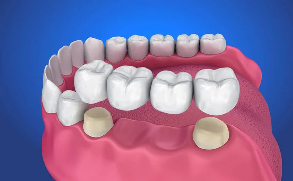 Zubní Podporovaný Pevný Můstek Lékařsky Přesné Ilustrace — Stock fotografie