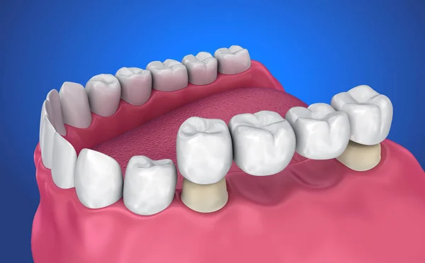 Dente Suportado Ponte Fixa Ilustração Medicamente Precisa — Fotografia de Stock