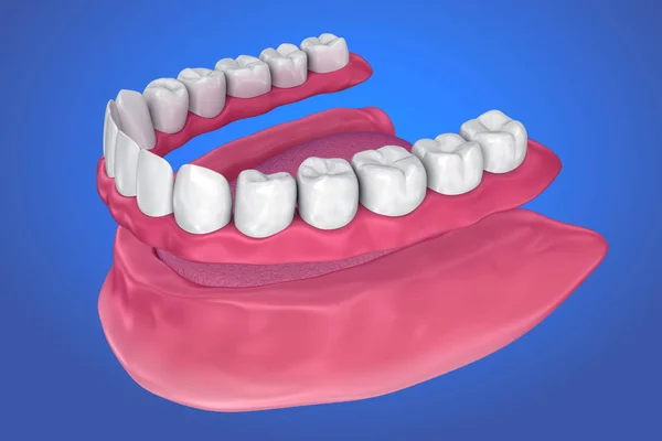 Todos Los Dientes Faltantes Dentadura Postiza Completa Extraíble Ilustración —  Fotos de Stock