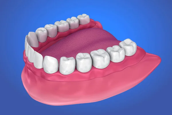 All missing teeth - removable full denture. 3D illustration