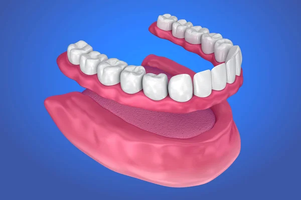 Tutti Denti Mancanti Protesi Completa Rimovibile Illustrazione — Foto Stock