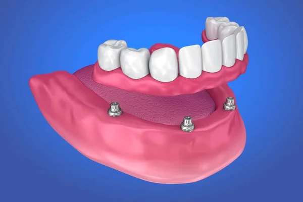Fixed bridge on implants. Medically accurate 3D illustration
