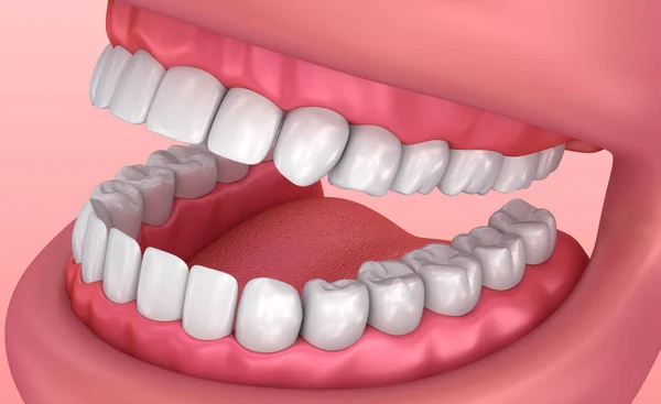 口腔口香糖和牙齿 医学上精确的牙3D — 图库照片